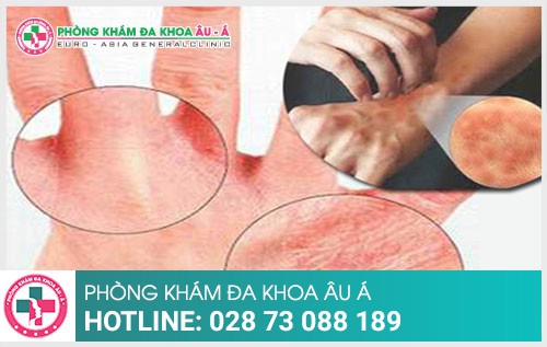 Bạn có đang thắc mắc vì sao mình bị ghẻ - Phòng Khám Đa Khoa Âu Á