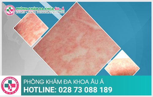 Bệnh chàm và cách điều trị hiệu quả