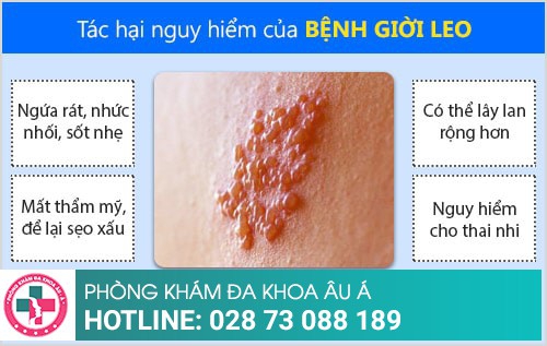 Tất tần tật những kiến thức về bệnh giời leo