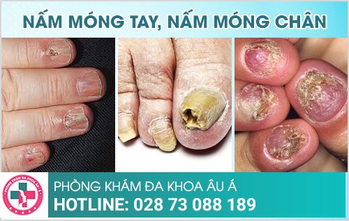 nấm móng tay, nấm móng chân