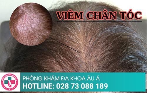 Bệnh viêm chân tóc chữa thế nào hiệu quả?