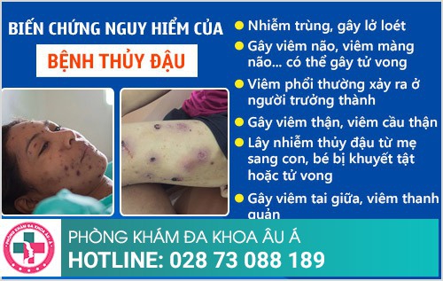 biến chứng của bệnh thủy đậu