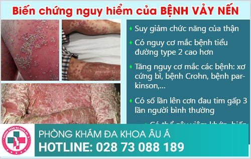 Bệnh vảy nến và những thông tin cần biết