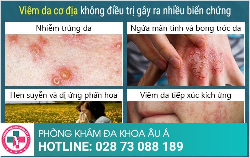 viêm da cơ địa