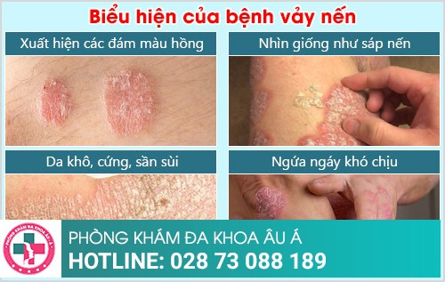 Bệnh vảy nến và những thông tin cần biết