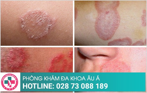 cách chữa bệnh hắc lào