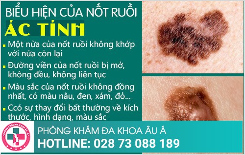 địa chỉ phá nốt ruồi