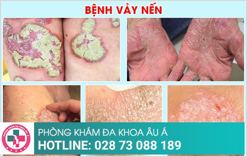 chữa vảy nến ở đâu