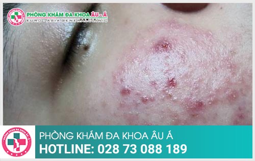 Cách chấm dứt viêm da dị ứng ở mặt hiệu quả - Phòng Khám Đa Khoa Âu Á