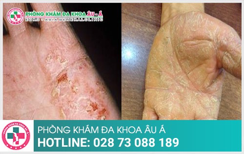 Cách hỗ trợ điều trị bệnh chàm bằng dầu dừa cho kết quả cao - Phòng Khám Đa Khoa Âu Á