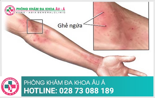 Cách hỗ trợ điều trị bệnh ghẻ nhanh khỏi  - Phòng Khám Đa Khoa Âu Á