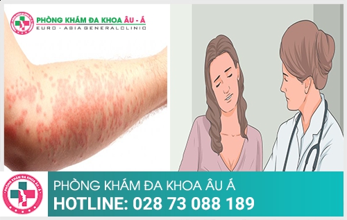 Cách hỗ trợ điều trị chàm ở tay hiệu quả