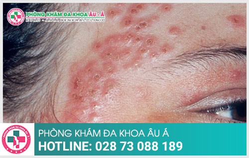 Cách điều trị bệnh chàm hiệu quả không ngờ - Phòng Khám Đa Khoa Âu Á