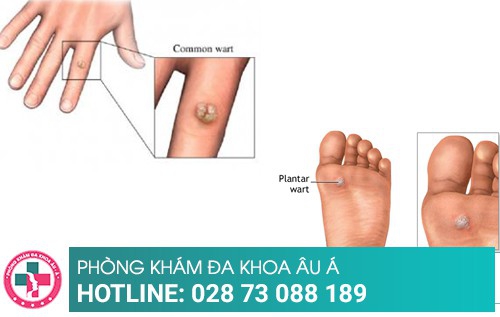 Cách điều trị mụn cóc như thế nào hiệu quả?