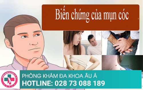Cách điều trị mụn cóc như thế nào hiệu quả?