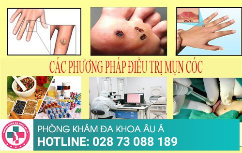 Cách điều trị mụn cóc như thế nào hiệu quả?