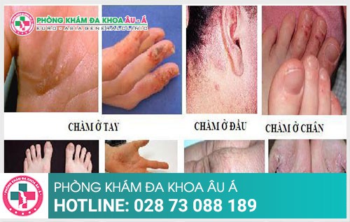 Cách phòng tránh bệnh chàm hiệu quả - Phòng Khám Đa Khoa Âu Á