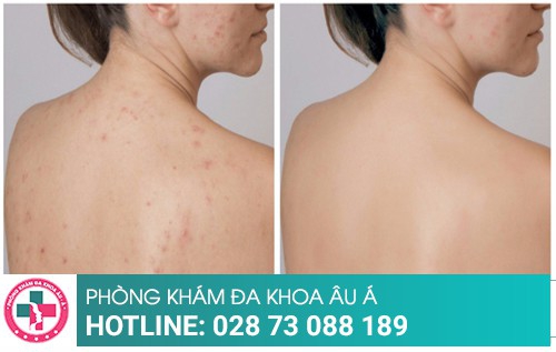 Cách trị mụn lưng đơn giản, đạt hiệu quả cao