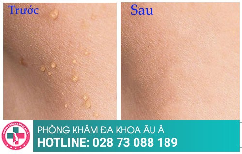 Cách trị mụn thịt bằng phương pháp tiên tiến