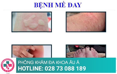 Cách trị nổi mề đay hiệu quả chưa từng thấy