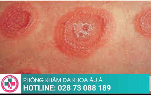Chữa lác đồng tiền như thế nào hiệu quả, an toàn