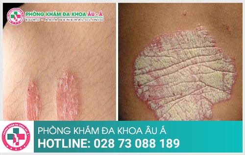 Có nên điều trị bệnh vảy nến tại nhà hay không - Phòng Khám Đa Khoa Âu Á