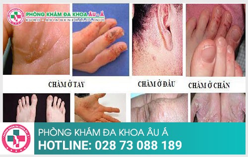 Đã có thuốc chấm dứt Eczema hiệu quả - Phòng Khám Đa Khoa Âu Á
