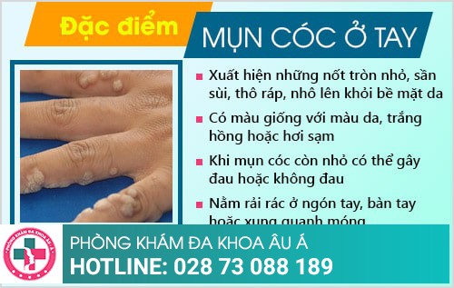 mụn cóc ở tay