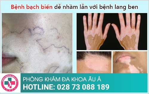 dấu hiệu bạch biến