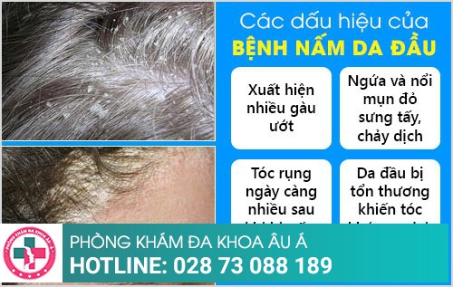 dấu hiệu nấm da đầu