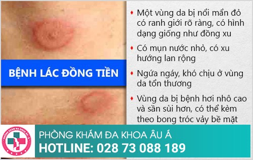 Lác đồng tiền