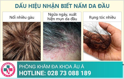 Cách chữa nấm da đầu hiệu quả chỉ trong 1 liệu trình