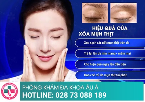 Cách khắc phục bị nổi mụn thịt dư hiệu quả 