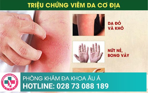 Điều trị viêm da cơ địa hiệu quả tại Da Liễu Âu Á