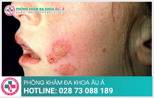 Ghẻ lở và mẹo điều trị hiệu quả  hiện nay