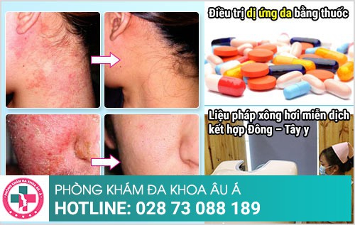 dị ứng da