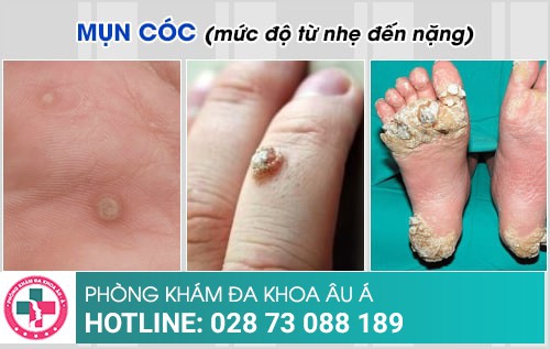 mụn cóc