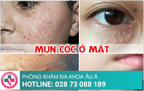 Mụn cóc ở mặt: Dấu hiệu và cách điều trị