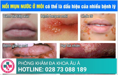 mụn nước ở môi