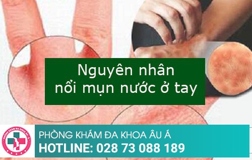 Mụn nước ở tay là bệnh gì? phải làm sao?