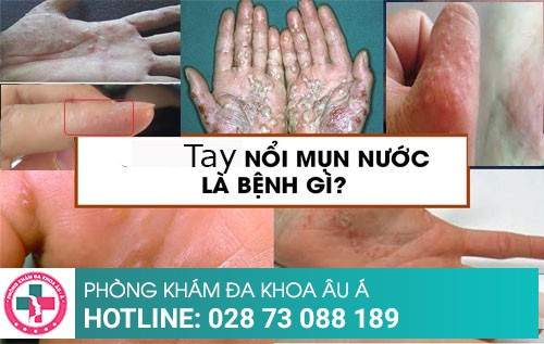 Mụn nước ở tay là bệnh gì? phải làm sao?