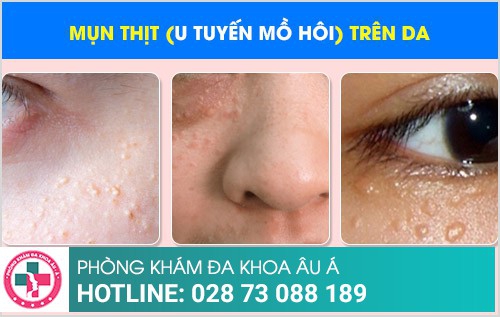 Mụn thịt và giải pháp hỗ trợ điều trị hiệu quả