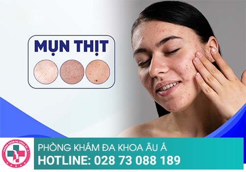 Nguyên nhân bị nổi thịt dư