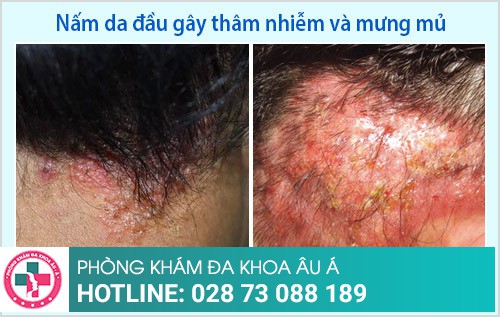 4. Phòng Ngừa Tái Phát Nấm Da Đầu Có Mủ