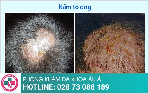 điều trị nấm da đầu