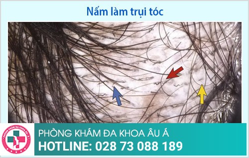 điều trị nấm da đầu