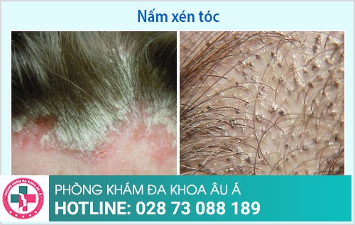 điều trị nấm da đầu