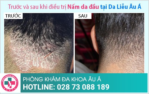 điều trị nấm da đầu