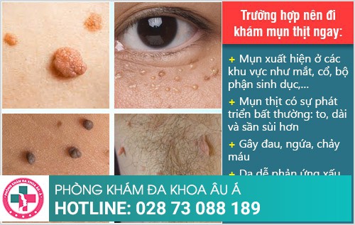 Địa chỉ chữa mụn thịt uy tín