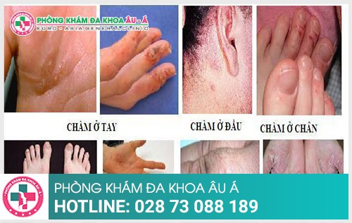 Nguy hiểm không ngờ do bệnh chàm gây ra - Phòng Khám Đa Khoa Âu Á